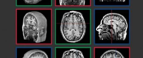 What is PET Scan for Brain: Unveiling the Secrets of Brain Imaging